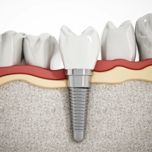 3D image of dental implant