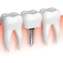  Illustration of dental implant