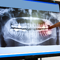 Digital x-ray showing patient's teeth