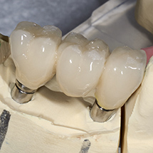 Fixed dental bridge