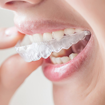 Female patient putting on invisalign clear braces