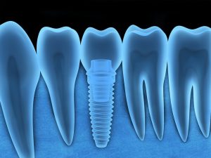 Learn why dental implants from your dentist in Joplin are the gold standard for artificial teeth. 