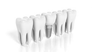 dental implants